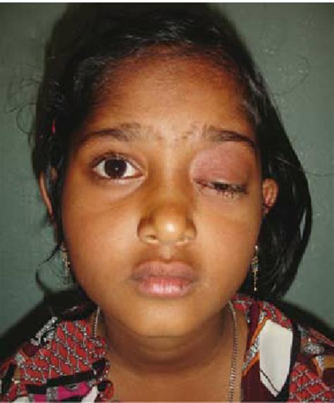 Photograph Of The Patient At Presentation Shows Swelling And Ptosis Of