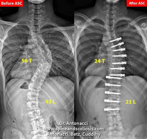 scoliosis and kyphosis institute for spine and scoliosis my xxx hot girl