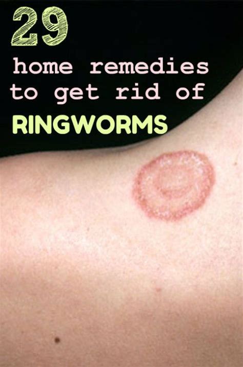 29 Home Remedies To Get Rid Of Ringworm Fast Get Rid Of Ringworm Home