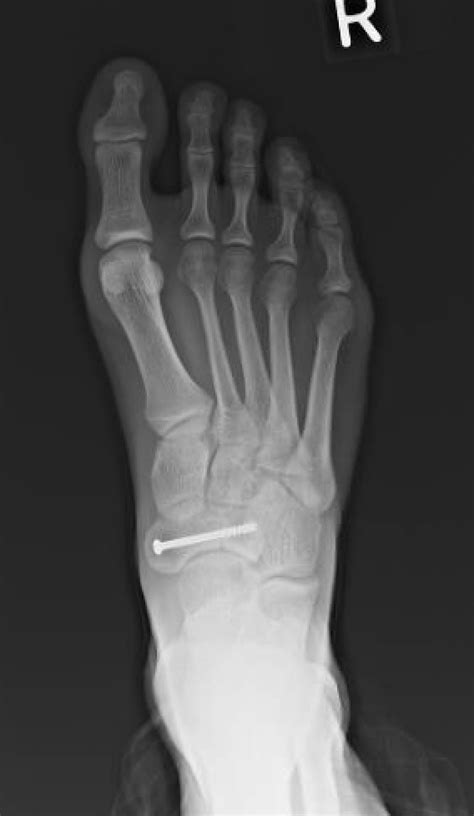 Rare Non Displaced Sagittal Plane Fractures Of The Navicular Body A