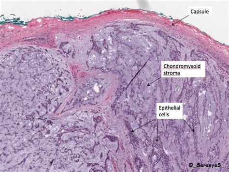 Pathology Of Pleomorphic Adenoma Pathology Made Simple