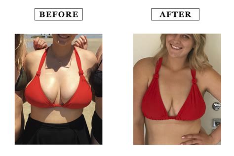 breast reduction before and after ddd