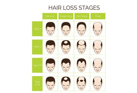How To Know If You Have Male Pattern Baldness