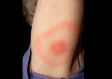 What Are The Symptoms Of A Brown Recluse Spider Bite Hobo Spider Bite