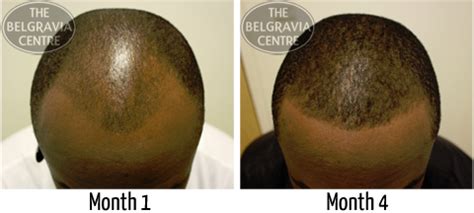 Natrol nuhair hair regrowth for men. "Do Your Hair Loss Treatments Work on Black Men?"