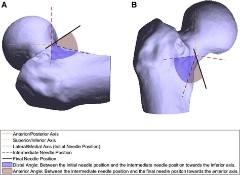 An Anatomic Analysis Of Mid Anterior And Anterolateral Approaches For
