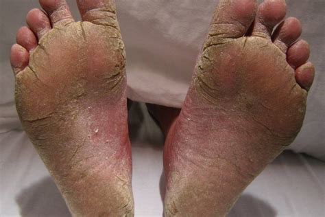 Best Fungal Infection Specialist In Delhi Fungal Infection Treatment
