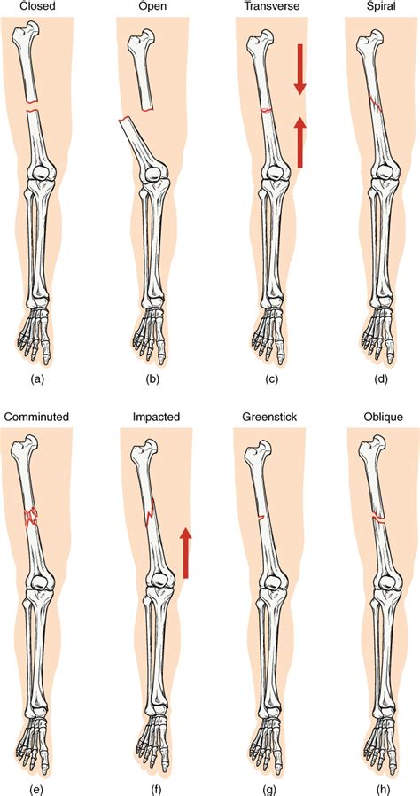 Types Of Bone Fractures Imaging And Management Lecturio