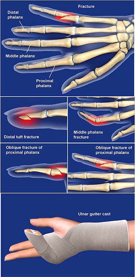 Fractures Of The Finger Central Coast Orthopedic Medical Group