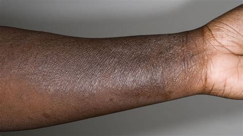 Why Doctors Misdiagnose Skin Of Color