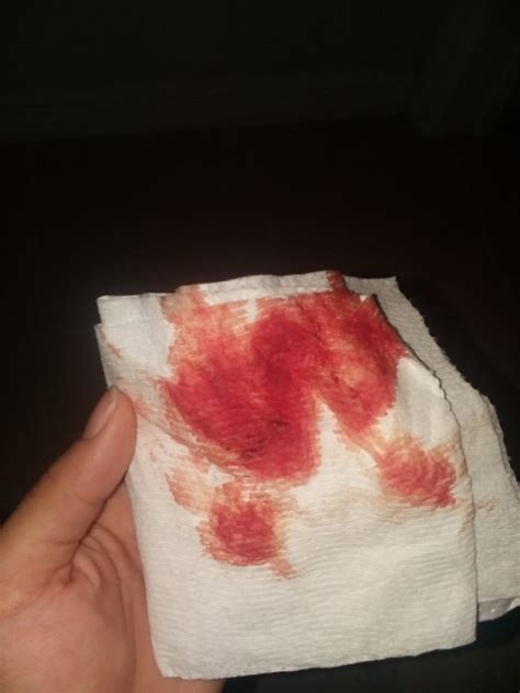 Is This Implantation Bleeding Period Was 4 Days Late Brown Spotting