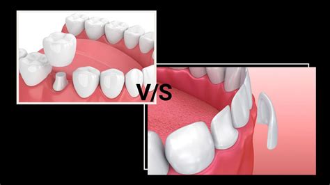 Dentures Vs Veneers Which Is The Best Option