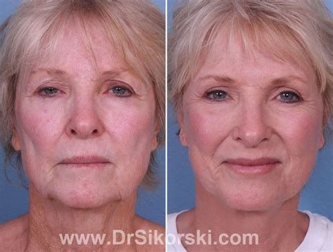 Orange County Neck Lift Before And After Photos Dr Sikorski Natural