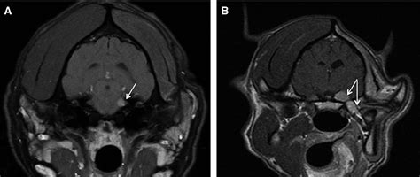 Treatment Of Mri‐diagnosed Trigeminal Peripheral Nerve Sheath Tumors By