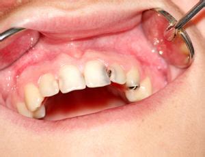 Carie Dentaire Causes Symptômes et Traitements