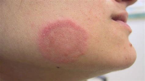 Ringworm Tinea Causes Signs Symptoms Diagnosis And Treatment