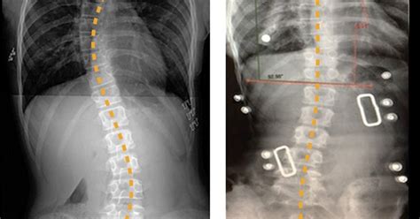 Non Surgical Treatment For Scoliosis