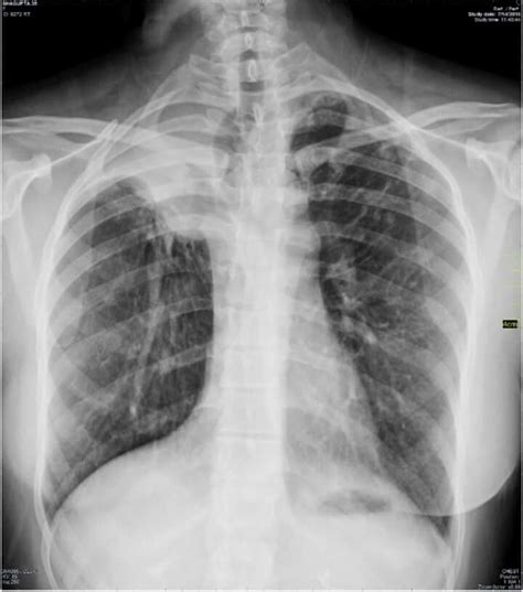 Right Upper Lobe Collapse Golden S Sign Radiology Student Radiology