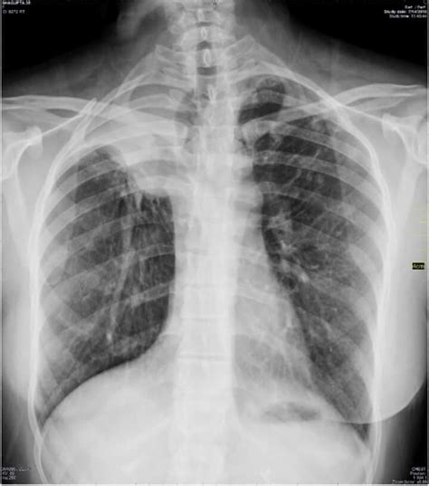 Right Upper Lobe Collapse Golden S Sign Medical Ultrasound Basic