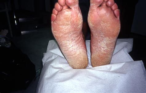 Superficial Fungal Infections Tinea Pedis Athlets Foot Picture