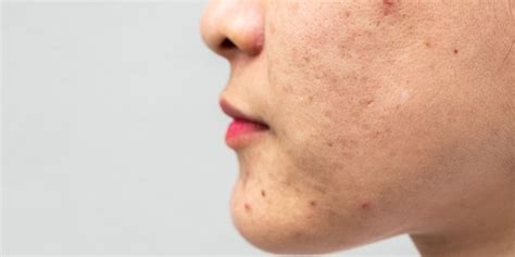 How To Get Rid Of Clogged Pores In 2024 Treatment And Prevention