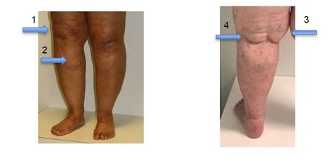 Understanding Lipedema And Empowering Our Patients Lymphatic