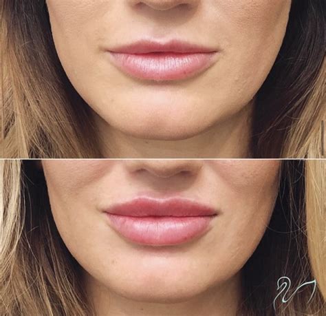 1 Syringe Of Juvederm Lips Before And After