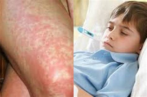 Scarlet Fever On The Rise Could It Be Causing Your Sore Throat