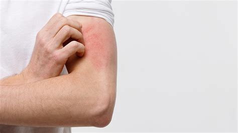 Acute And Chronic Hives And Rashes Causes And Treatments By Brynna