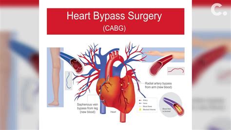 What Is Coronary Artery Bypass Grafting