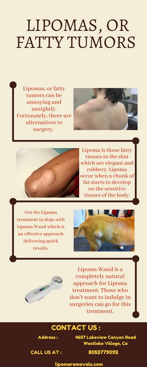 Ppt Lipoma Treatment Without Surgery Lipoma Wand Powerpoint