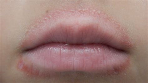 Red Spots On Baby S Lips Lipstutorial Org
