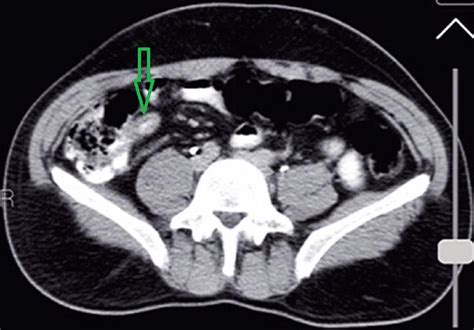 Abdominal Ct‐scan The Green Arrow Shows Appendix Filled By Iv Contrast