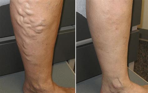 How To Get Rid Of Varicose Veins And Spider Veins