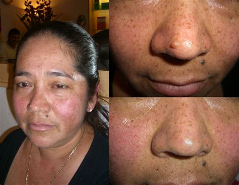 Skin Blemish Removal The Spa Lounge