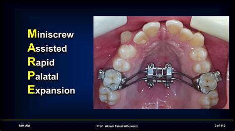 Marpe Miniscrew Assisted Rapid Palatal Expansion Live Webinar Youtube