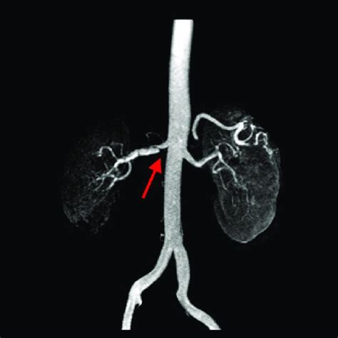 Angiography And Stent Implantation In The Right Renal Artery