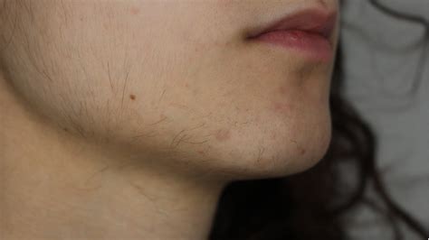 Discover More Than 52 Electrolysis Chin Hair Latest Vn