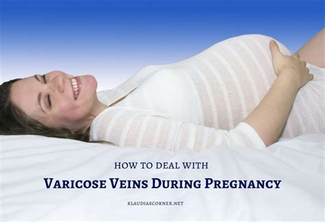 The Best Treatment For Varicose Veins During Pregnancy Klaudias Corner