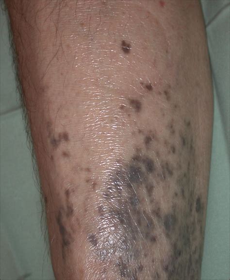 Speckled Posttraumatic Hyperpigmentation By Foreign Bodies On The Lower