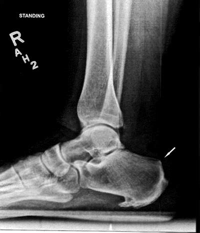 Wedge Osteotomy For Haglunds Syndrome And Associated Achilles