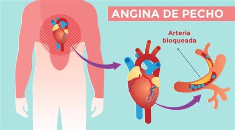 Síntomas y prevención de la angina de pecho Gullah Cusine