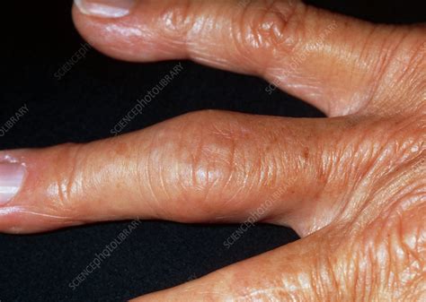 Hand Showing Fingers Affected By Osteoarthritis Stock Image M110