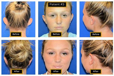 Otoplasty Protruding Ears Horizons Plastic Surgery Rome Ga