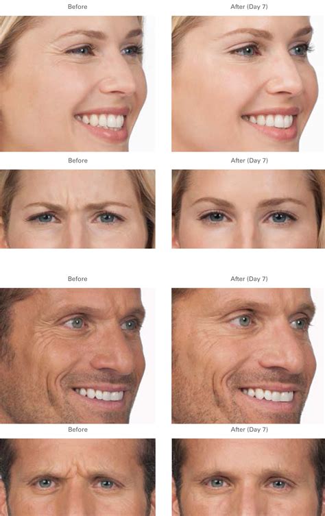 Botox eye lift before and after. Botox® | Hull Dermatology & Aesthetics