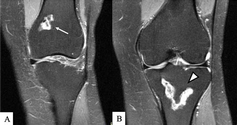 Cureus Atraumatic Medullary Osteonecrosis Of The Tibia And Femur
