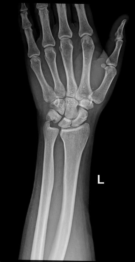 Ulnar Bone Fracture Classification Wikidoc
