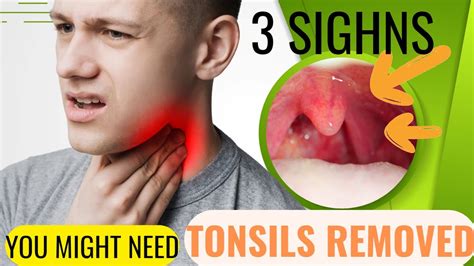 3 Signs You Might Need Your Tonsils Removed By Surgery Youtube
