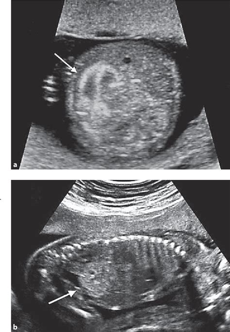 Perinatal Outcomes Following The Ultrasound Diagnosis Of Echogenic