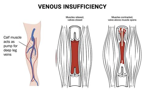 Venous Insufficiency Treatment In Nyc Nj Vein Care Center